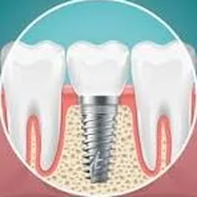 Implantes dentales de titanio